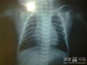 支气管肺炎吃皇瓜好吗,支气管肺炎患者适宜食用皇瓜吗？