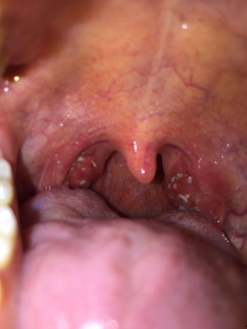 灵宝吃瓜喉咙疼,揭秘瓜果美食背后的健康隐患